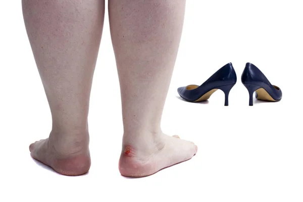 Pés femininos com calo a pé — Fotografia de Stock