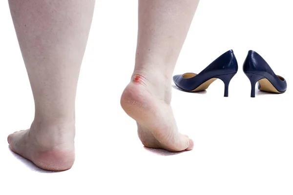 Female feet with callus on foot — Stock Photo, Image