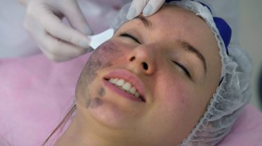 Karbon yüz soyma işlemi.