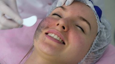 Karbon yüz soyma işlemi.