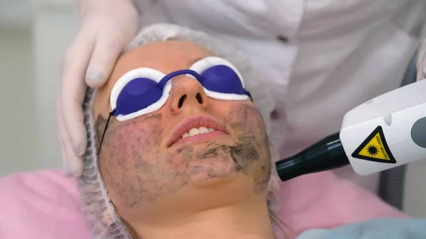 Carbon face peeling procedure. — Stock Photo, Image