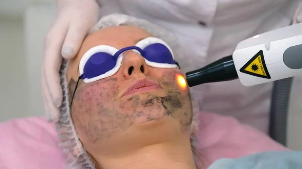 Carbon face peeling procedure. — Stock Photo, Image