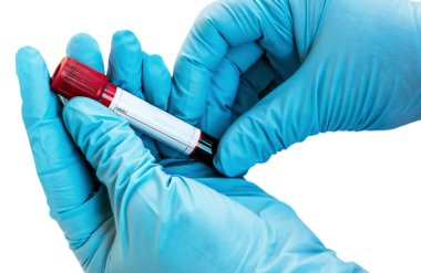 2019-nCoV Coronavirus Wuhan Çin vakum kan tüpü Doktor El 'i beyaz arka planda izole edilmiş mavi eldivenle test edin.