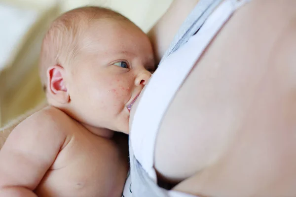 Pasgeboren Baby Borstvoeding Baby Met Een Baby Uitslag — Stockfoto