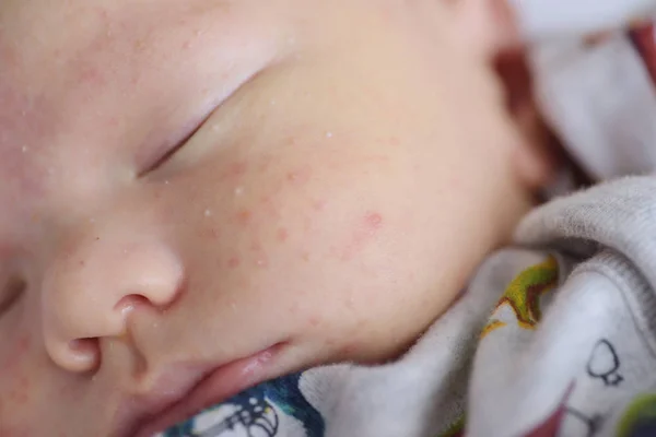 Baby uitslag close-up — Stockfoto