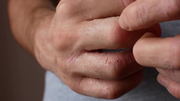 Der Mann kratzt sich an den Händen. sehr juckende Finger, Schuppenflechte. — Stockvideo