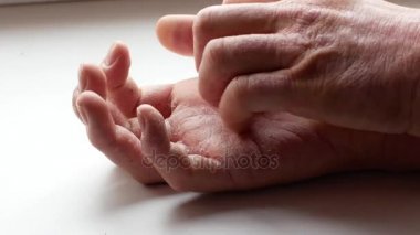 Adam ellerini çizikler. Çok kaşıntılı parmakları, sedef.