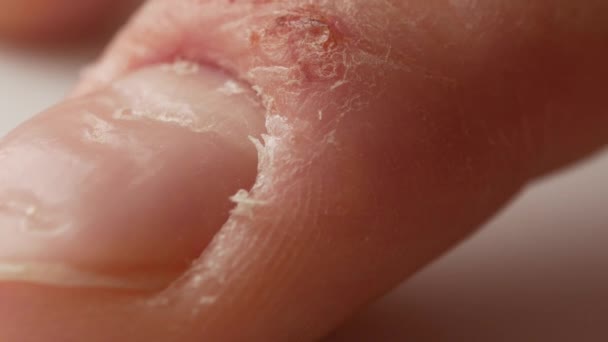 Dedos y uñas de un paciente con psoriasis. El hombre golpea nerviosamente la punta de su dedo sobre la mesa . — Vídeo de stock