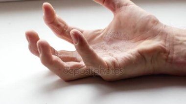 Adam ellerini çizikler. Çok kaşıntılı parmakları, sedef.