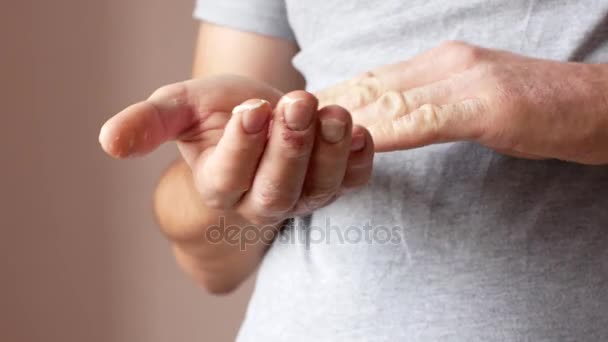 Um homem esfrega as mãos com creme. Mãos do paciente com psoríase. Dermatite na pele . — Vídeo de Stock