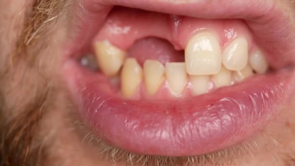 Primer plano de los dientes. Un hombre muestra su dentadura postiza en dos dientes. No hay suficientes dos dientes, en lugar de ellos una prótesis de plástico — Vídeo de stock