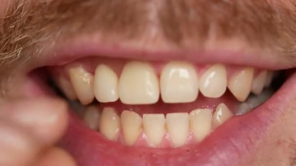 Close-up of teeth. A man shows his denture on two teeth. There are not enough two teeth, instead of them a plastic prosthesis — Stock Video