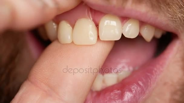 Närbild av tänder. En man visar sin protes på två tänder. Det finns inte tillräckligt två tänder, i stället för dem en plast protes — Stockvideo