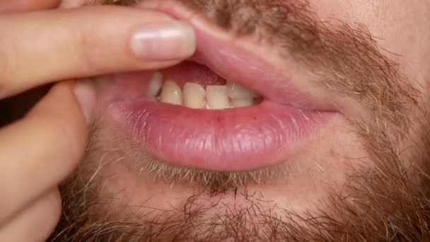 Un dentista muestra la boca de un hombre con los dientes rotos — Vídeos de Stock