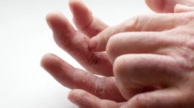 Mans palm sedef ile kapılmış. Ağrı ve taraklama can sıkıcı bir durum ve convulsively sıkmak el neden olur