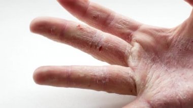 Mans palm sedef ile kapılmış. Ağrı ve taraklama can sıkıcı bir durum ve convulsively sıkmak el neden olur