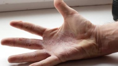 Mans palm sedef ile kapılmış. Ağrı ve taraklama can sıkıcı bir durum ve convulsively sıkmak el neden olur