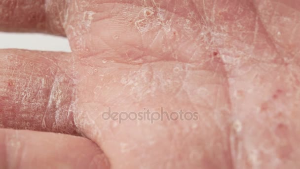 Пальцы человека с псориазом и экземой. Крупный план пилинга кожи — стоковое видео