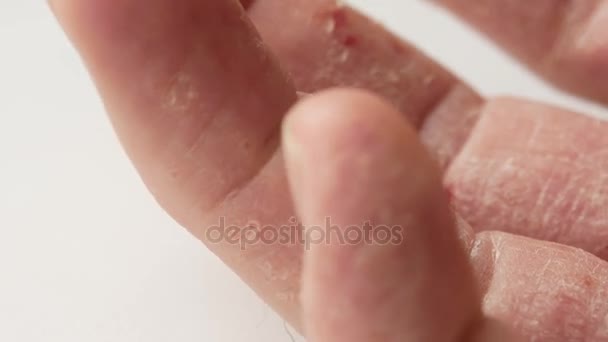 Dita di un uomo con psoriasi ed eczema. Un primo piano del peeling cutaneo — Video Stock