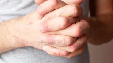 Egzama etkilenen elleri olan bir adam. Erkek el yakın çekim