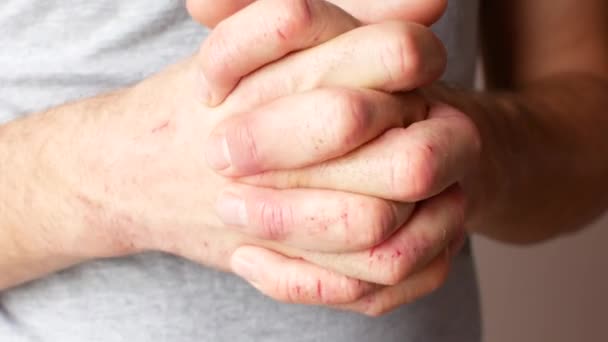 Человек с пораженными экземой руками. Мужские руки крупным планом — стоковое видео