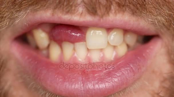 Primer plano de los dientes. Un hombre muestra su dentadura en dos dientes . — Vídeo de stock