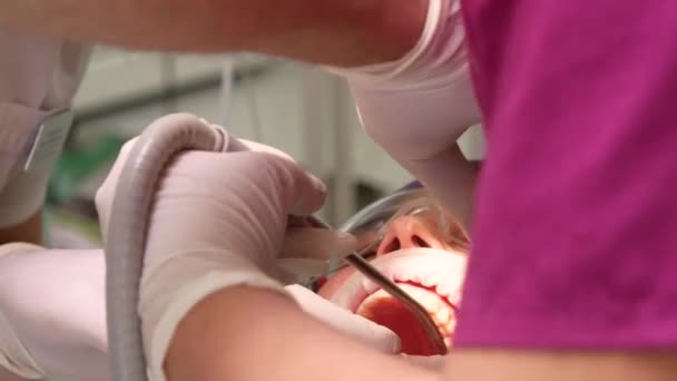 Um dentista com um assistente remove o dente de uma jovem — Vídeo de Stock