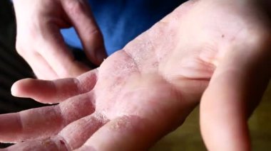 Adam ellerini çizikler. Çok kaşıntılı parmakları, sedef.