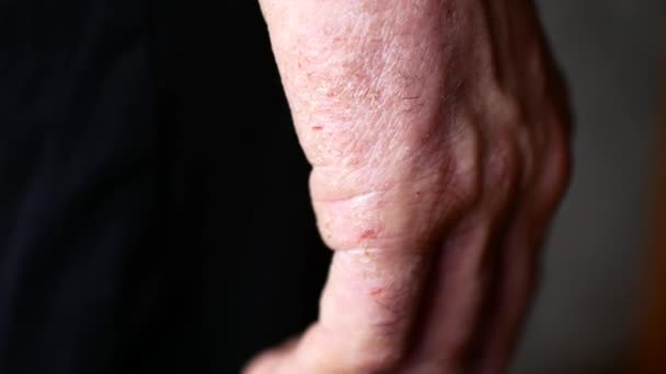 The man scratches his hands. Very itchy fingers, psoriasis. — Stock Video