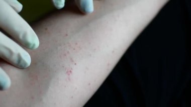 Sedef hastalığı olan bir adam elinde eldiven doktor inceliyor.