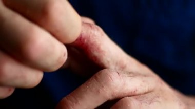 Adam ellerini çizikler. Çok kaşıntılı parmakları, sedef.