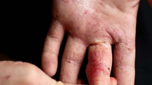 El hombre se rasca las manos. Dedos muy picantes, psoriasis . — Vídeos de Stock