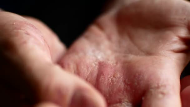 Les mains malades demandent la charité. Mains d'un homme atteint de psoriasis . — Video