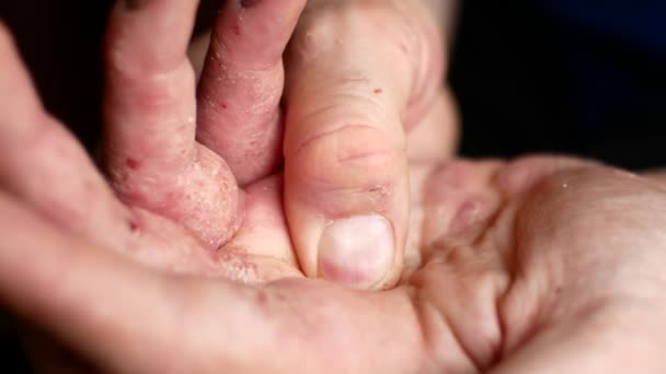 Sjuka mens händer ber för välgörenhet. Händerna på en man med psoriasis. — Stockvideo
