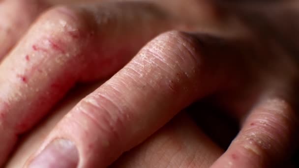 Muž poškrábání ruce. Velmi svědí prsty, psoriáza. — Stock video