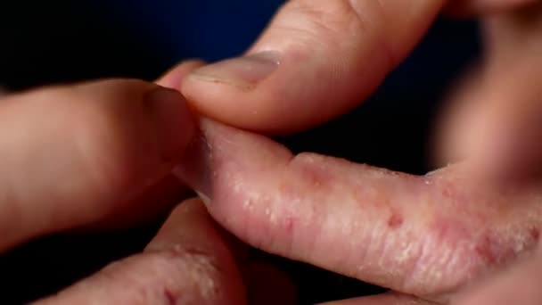 Mannen skrapar händerna. Mycket kliande fingrar, psoriasis. — Stockvideo