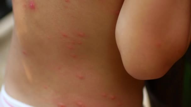 Mordeduras de mosquitos y otros insectos en la parte posterior del niño . — Vídeo de stock