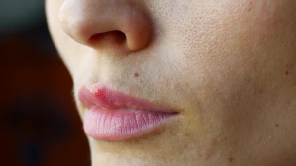 Herpes auf der Lippe eines Mädchens — Stockvideo