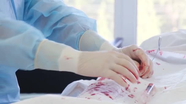 Τρυπημένη Βολή Από Χέρια Χειρουργού Ιατρική Ενδοσκόπηση Χειρουργική — Αρχείο Βίντεο
