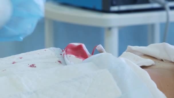 Cerrahın Eli Kesilmiş Tıbbi Endoskopi Ameliyatı — Stok video