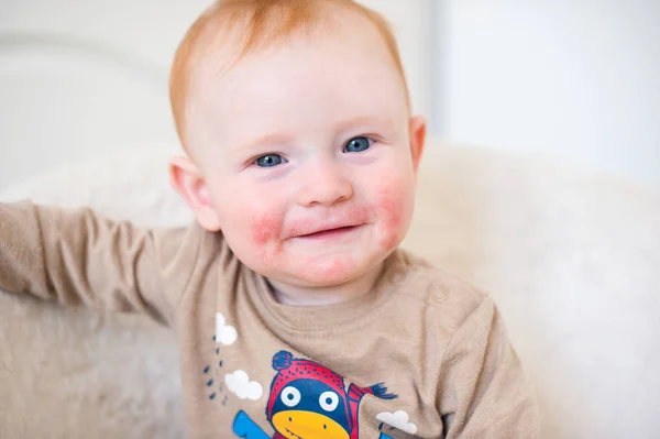 Niño pelirrojo con dermatitis atópica — Foto de Stock