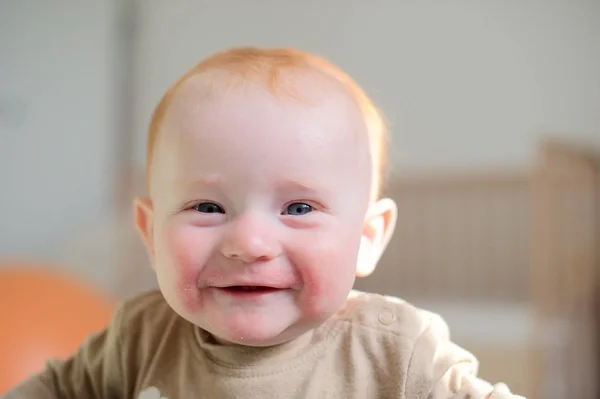 Piękne redhead dla niemowląt z atopowym zapaleniem skóry — Zdjęcie stockowe