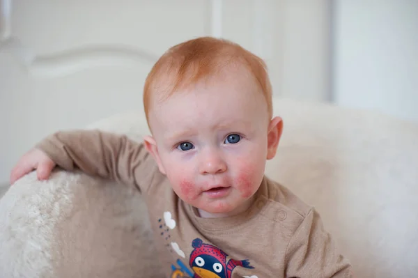 Redhead dítě s atopickým ekzémem — Stock fotografie