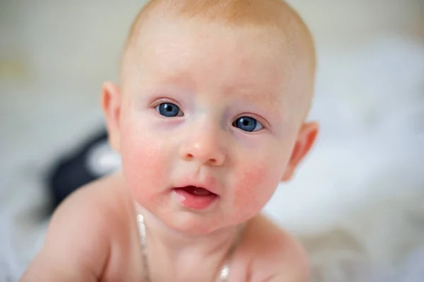 La cara de un bebé recién nacido con dermatitis atópica — Foto de Stock