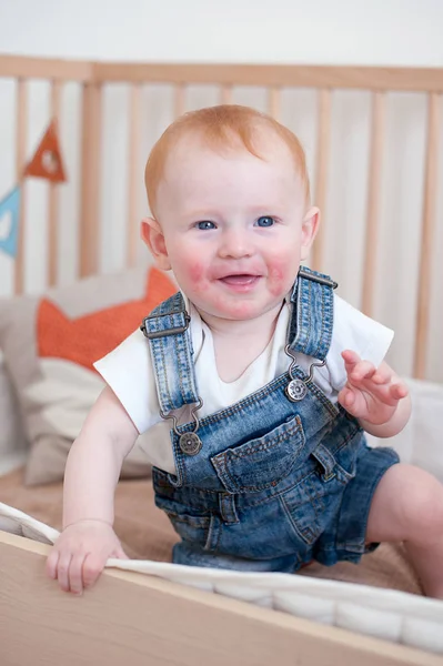 Bambino con dermatite atopica — Foto Stock