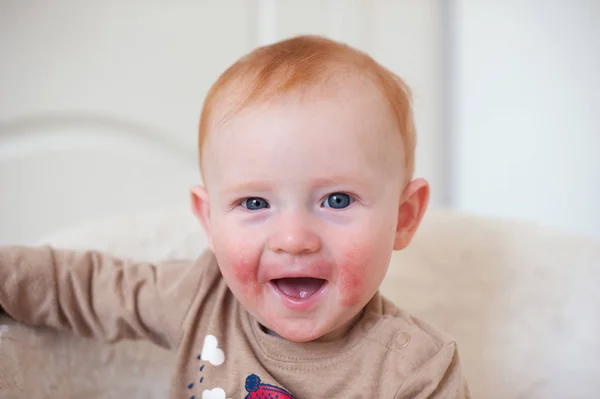 Bambino dalla testa rossa con dermatite atopica — Foto Stock