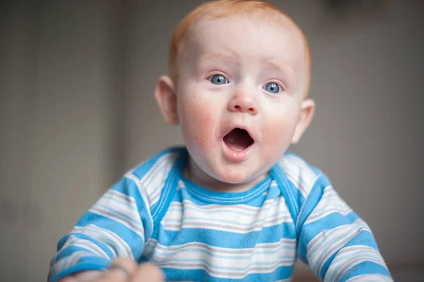 Menino com dermatite atópica — Fotografia de Stock