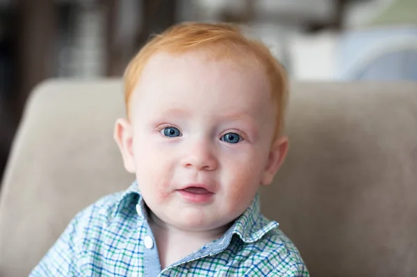 Gember Jongen Met Allergieën Atopische Dermatiti Zijn Gezicht — Stockfoto