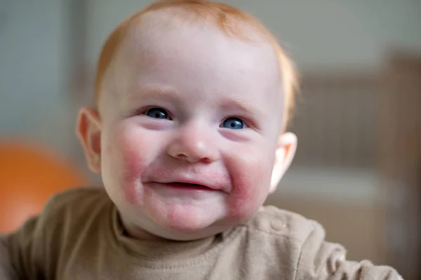 Bambino Con Allergia Atopica Sul Viso Primo Piano — Foto Stock