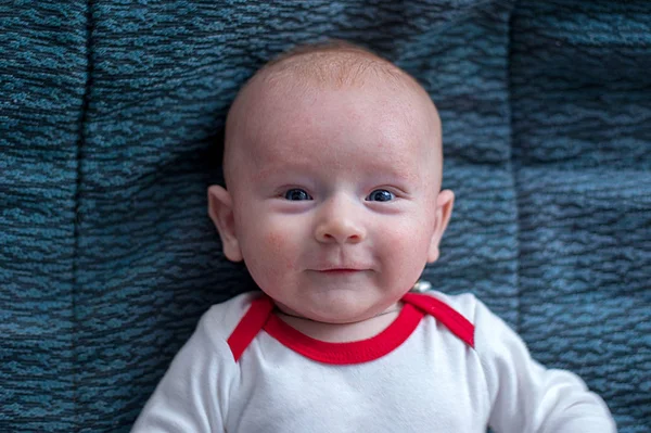 Baby with manifestations of food allergy on the face